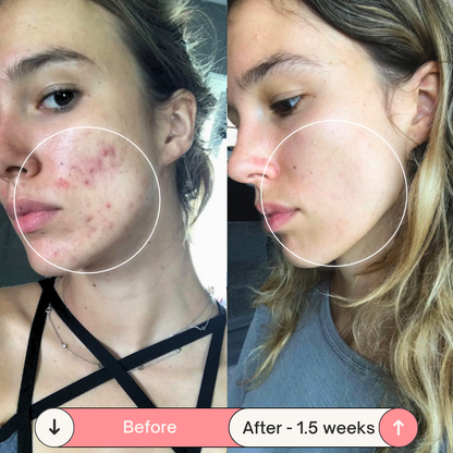 Skin Therapy - High Frequency Wand