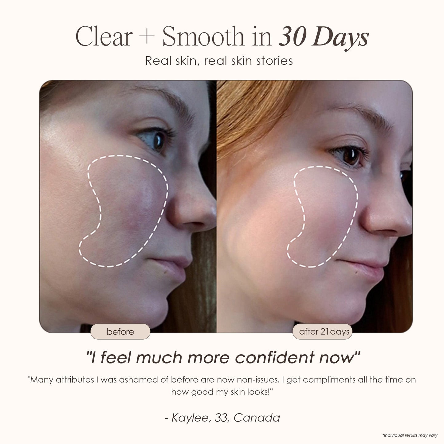 Skin Therapy - High Frequency Wand