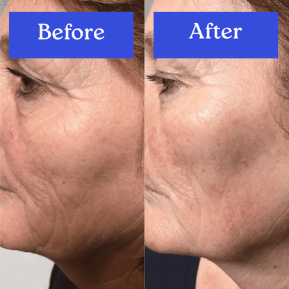 Skin Therapy - High Frequency Wand