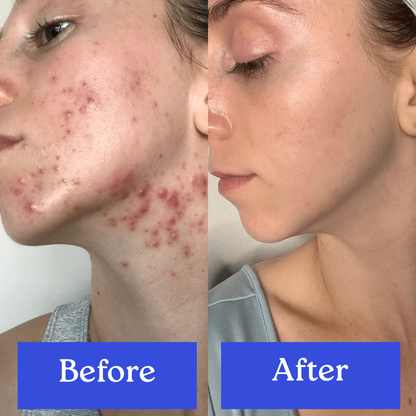 Skin Therapy - High Frequency Wand