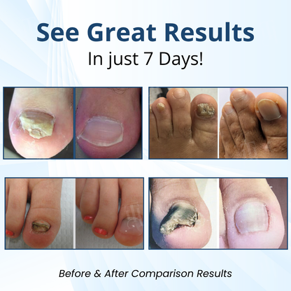 Fungal Nail Patches