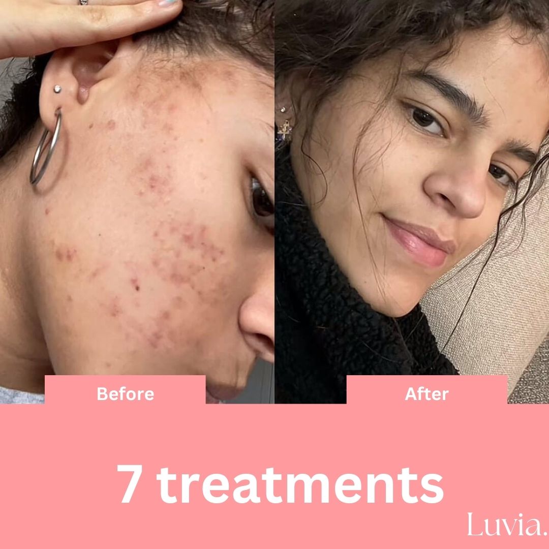 Skin Therapy - High Frequency Wand