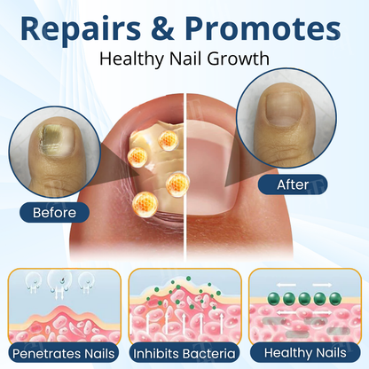 Fungal Nail Patches