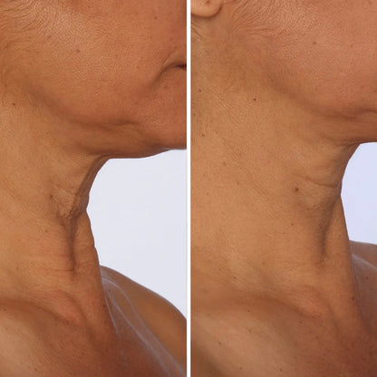 Roller Neck Cream Wrinkle Tightening