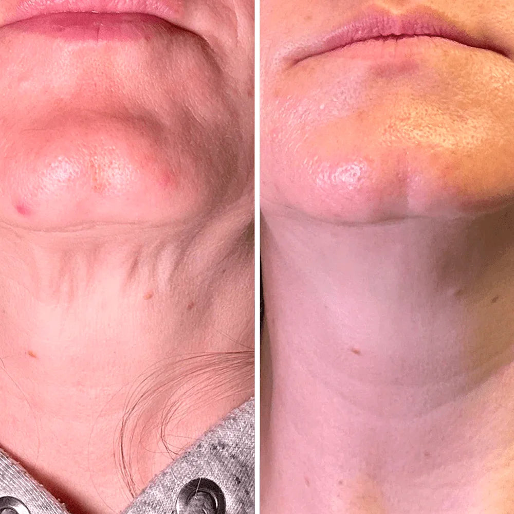 Roller Neck Cream Wrinkle Tightening