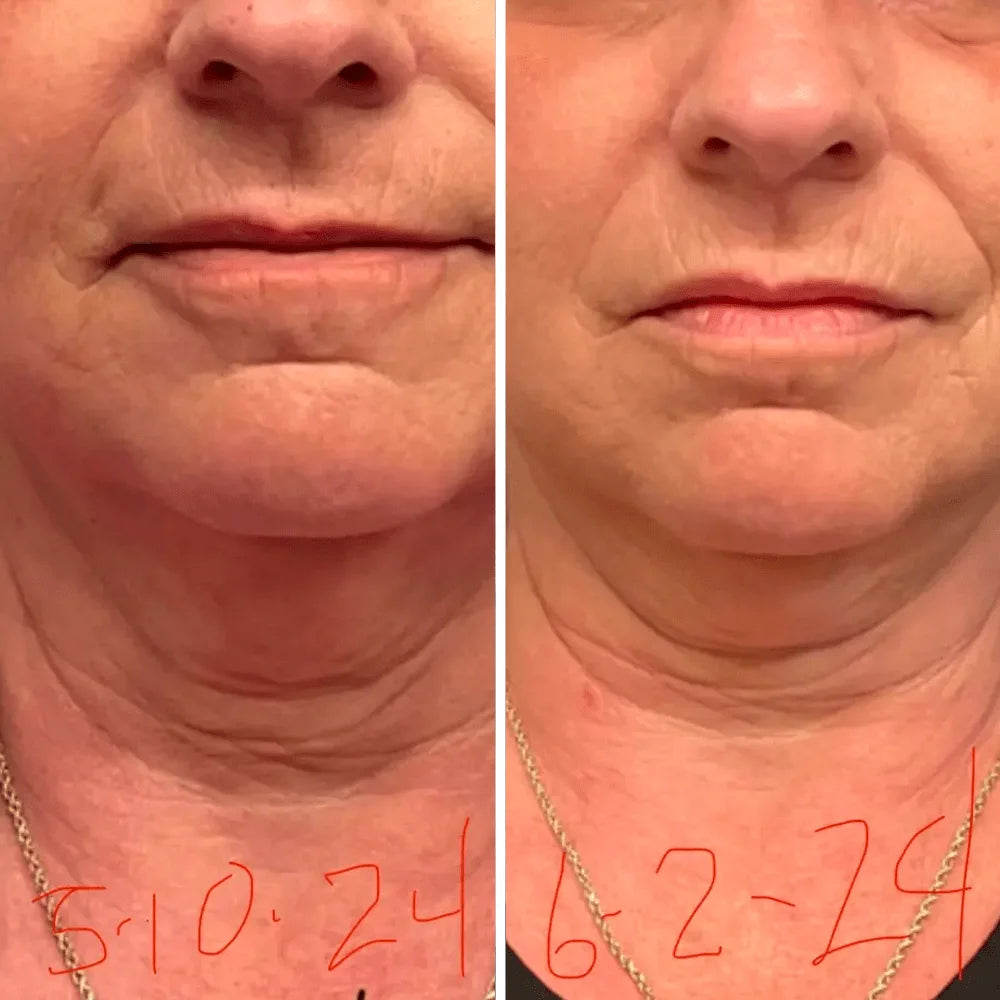 Roller Neck Cream Wrinkle Tightening