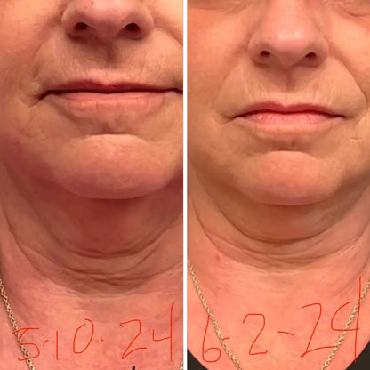 Roller Neck Cream Wrinkle Tightening