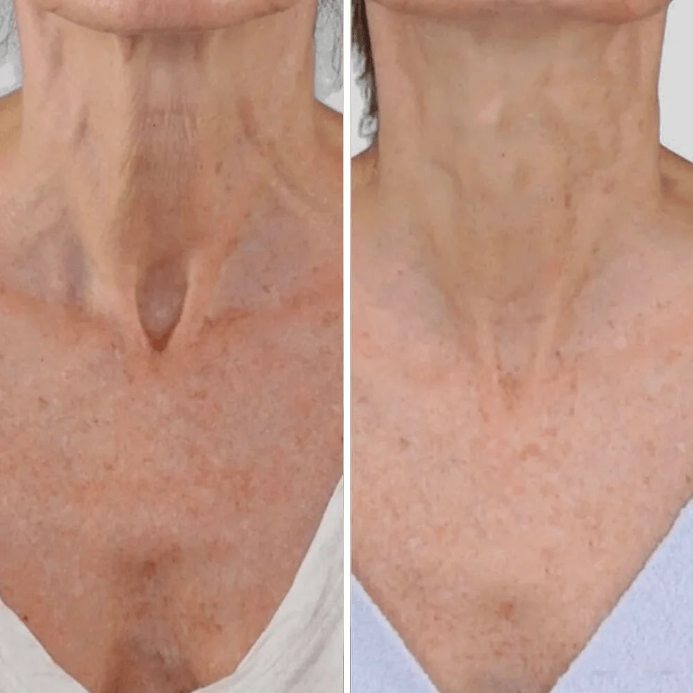 Roller Neck Cream Wrinkle Tightening