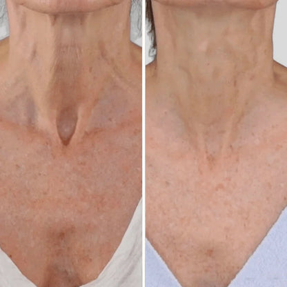 Roller Neck Cream Wrinkle Tightening