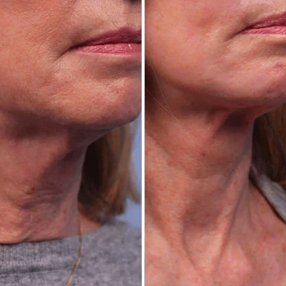 Roller Neck Cream Wrinkle Tightening