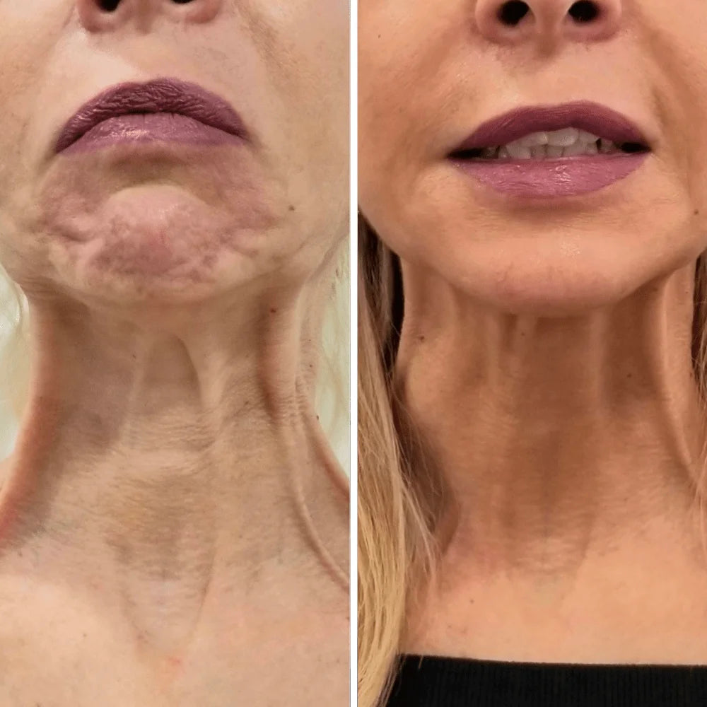 Roller Neck Cream Wrinkle Tightening