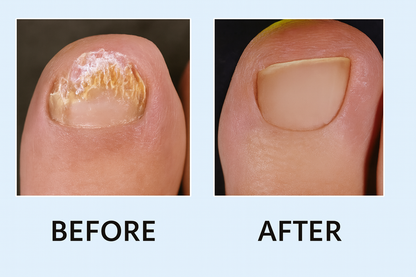 Bee Venom Nail Fungus