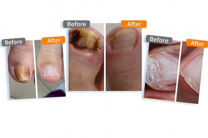 Bee Venom Nail Fungus