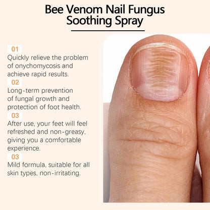Bee Venom Nail Fungus