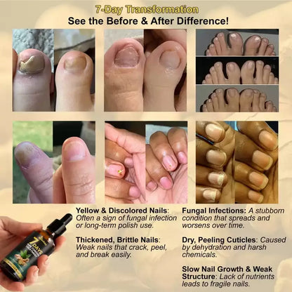 7 Days Nail Fungus Treatment Serum