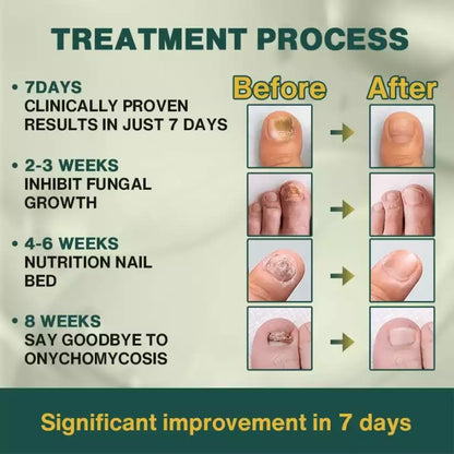 7 Days Nail Fungus Treatment Serum