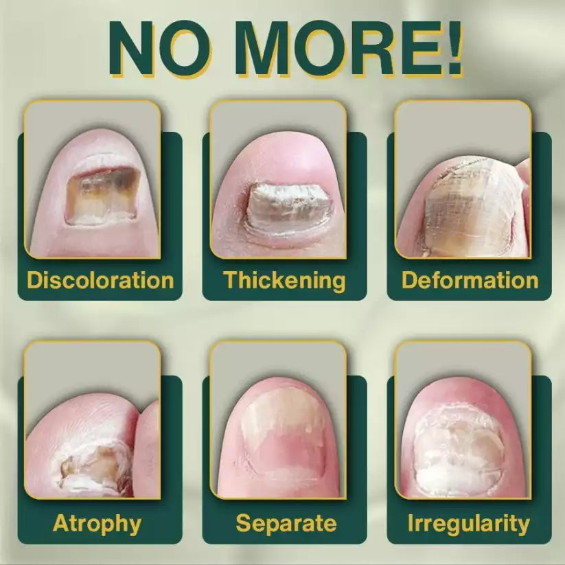 7 Days Nail Fungus Treatment Serum