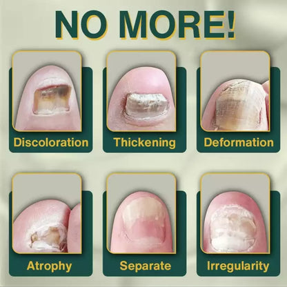 7 Days Nail Fungus Treatment Serum