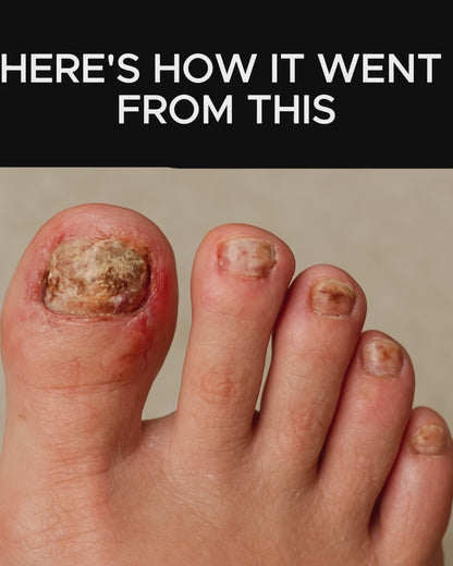 7 Days Nail Fungus Treatment Serum